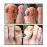 Health&Life™ - Parche de corrección de uñas de los pies